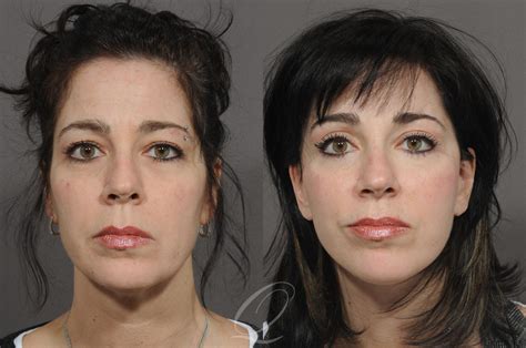 Mid Facelift for Rochester, Buffalo & Syracuse, NY | Quatela Center for Plastic Surgery