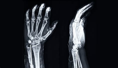 Xray Of Hand Bones