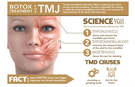 Botox for TMJ and Migraines | Highly Effective | - BEAUX MEDSPA