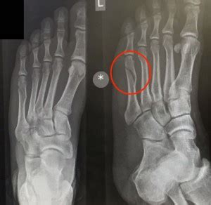 Breaking my 5th Metatarsal Bone - Spiral Fracture - KFFKR InsightsKFFKR Insights