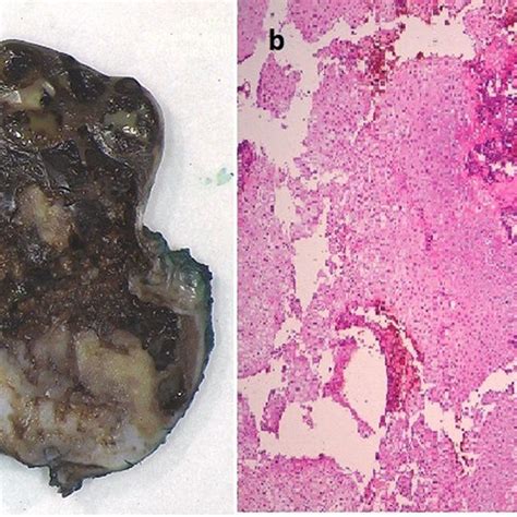 (A-C) Lung tissue with features of mesenchymal cystic hamartoma. | Download Scientific Diagram