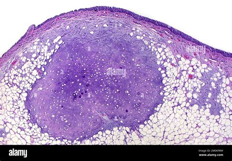 Lung hamartoma, light micrograph Stock Photo - Alamy