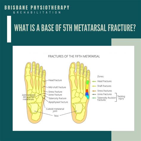 What is a Base of 5th Metatarsal Fracture? - Brisbane Physiotherapy