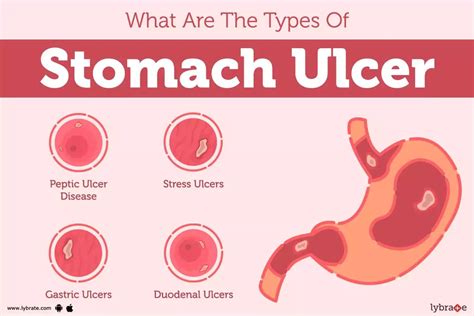 Stomach Ulcer: Causes, Symptoms, Treatment and Cost