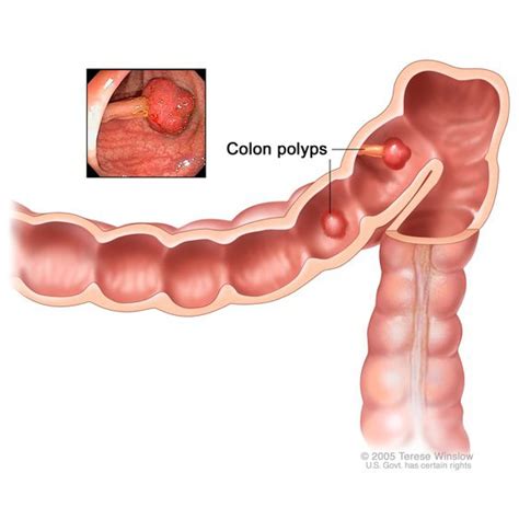 Colon Polyps - NIDDK