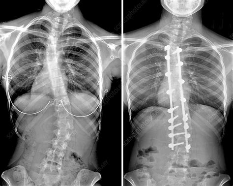 Scoliosis X Ray Before And After