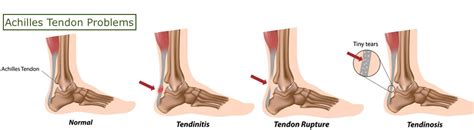 Ankle Pain: Causes and Treatments | Complete Pain Care