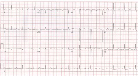 EKG Examples | Torrey EKG