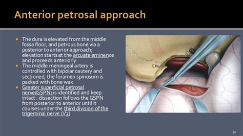 Petroclival Meningioma