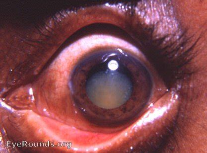 Morgagnian hypermature cataract: a rare shrinking stage. EyeRounds.org: Online Ophthalmic Atlas