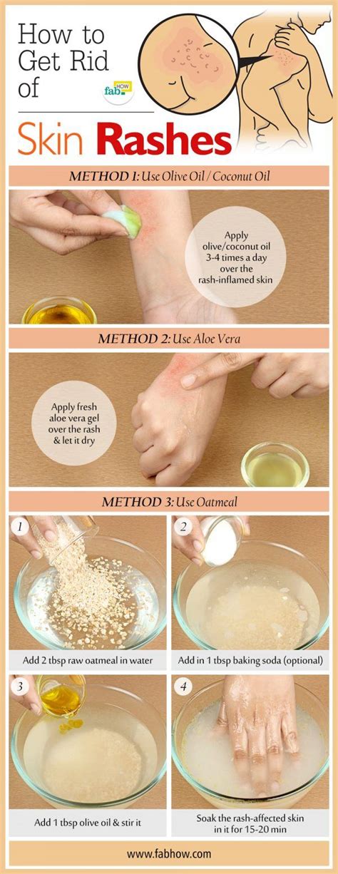 27+ How To Get Rid Of Heat Rash On Hands struggling to ]