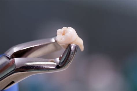 Is a Wisdom Tooth Extraction a Common Procedure? - King Dentistry Turlock California