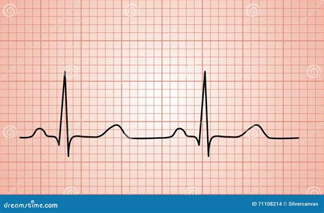 Graphique Normal Du Battement De Coeur ECG Illustration Stock - Illustration du formation ...