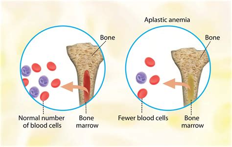 Anemia | Types, Causes, Symptoms, and Treatments