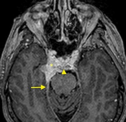 Petroclival meningioma | Radiology Case | Radiopaedia.org