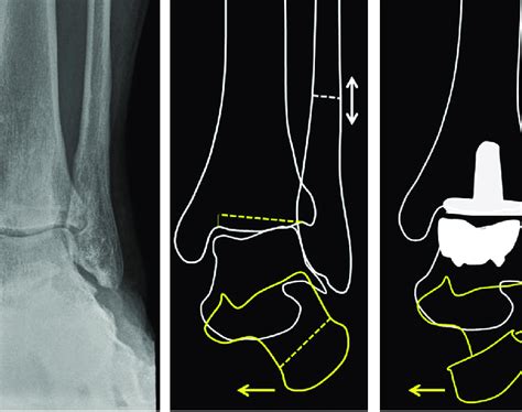 Ankle arthritis and valgus deformity in this case is related to an old... | Download Scientific ...