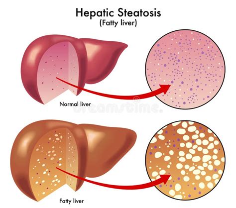 Hepatic steatosis stock vector. Illustration of acids - 22267876