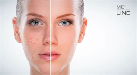 SKIN HYPERPIGMENTATION - INNOAESTHETICS