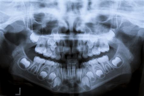 Why are OPG X-rays so essential for your oral health? - Healthy Smile ...