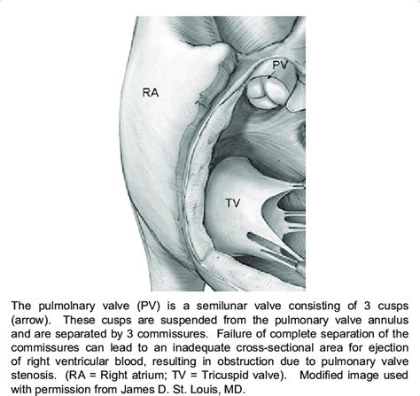 Pulmonary valve anatomy. | Download Scientific Diagram