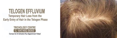 What is Telogen Effluvium? – Hair Loss Clinic | PRP, Laser Light Therapy Men & Women