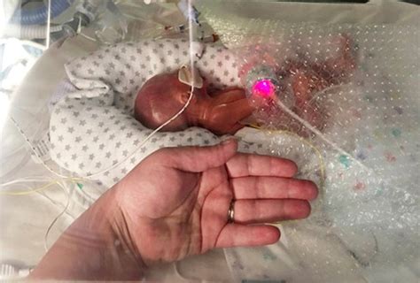 Premature baby born at 22 weeks thrives, hailed 'a miracle' - MadeForMums