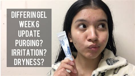 Differin Gel PURGING, IRRITATION, DRYNESS??? (Week 6 Update) - YouTube