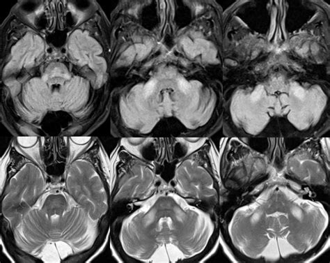 What is the most likely diagnosis in this 70 y/o w/ history of pontine infarct ~8 months ago now ...