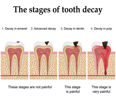 Stages-of-Tooth-Decay - South Gables Dental