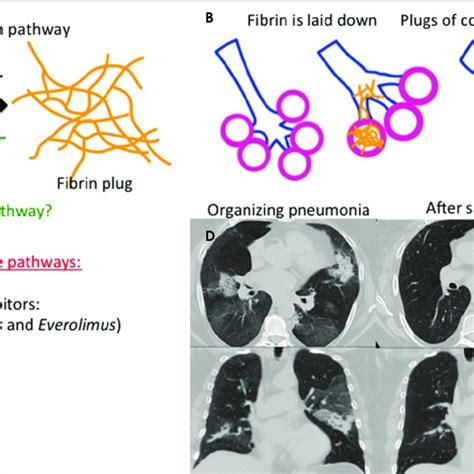 Pathophysiology of organizing pneumonia. Organizing pneumonia pattern... | Download Scientific ...