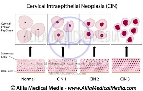 Stages Of Cervical Cancer Chart