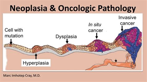 Neoplasia & Oncologic Pathology by Marc Imhotep Cray, M.D. - Issuu