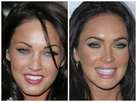 Pin on Plastic surgery. Perfect examples. Wanted. | Celebrity teeth, Celebrities with veneers ...