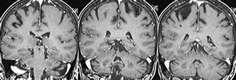 What is the most likely diagnosis in this 70 y/o w/ history of pontine infarct ~8 months ago now ...