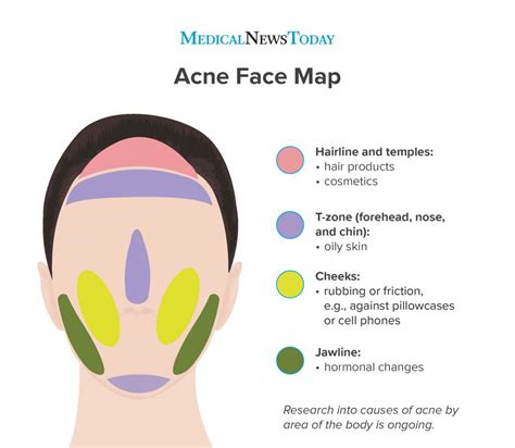 Mapa da face da acne: causas de fugas - Respostas Sempre Atualizadas