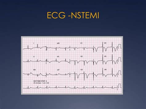 Nstemi Ecg