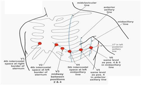 precordial-leads - Cardiac Sciences Manitoba