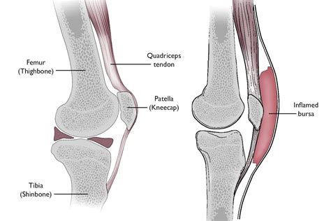 Prepatellar (Kneecap) Bursitis - OrthoInfo - AAOS