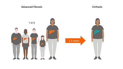 Liver fibrosis: Patients can be at risk of death even without exhibiting symptoms