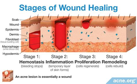 Surgical Wound Healing Stages