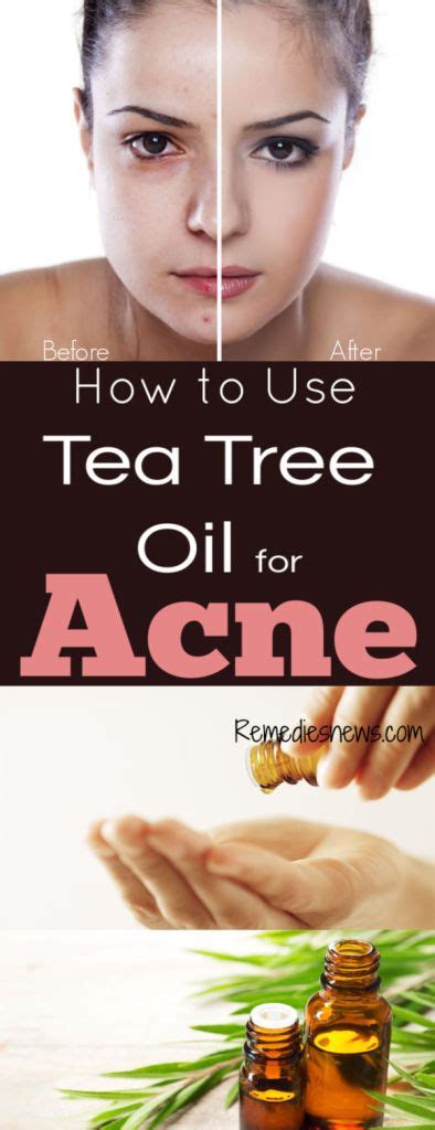 How to Use Tea Tree Oil for Acne : 11 Powerful Tea Tree Oil Recipes