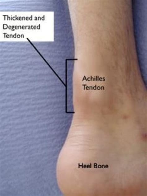 Achilles Tendinitis - Orthopedic & Sports Medicine