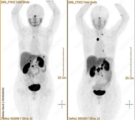 Pet bt ct scan or nuclear scan image of a patient showing normal skeleton of the whole body ...