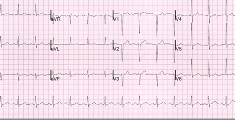 Dr. Smith's ECG Blog: Reversible T-wave inversion -- it reverses, then ...