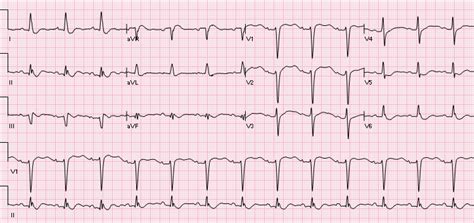 R.E.B.E.L. ECG of the Week #4 - REBEL EM - Emergency Medicine Blog