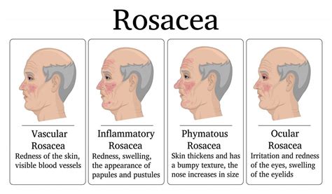 Best Essential Oil And Recipes For Rosacea Skin | Essential Oil Benefits