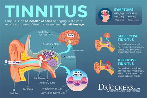 Tinnitus symptoms – Artofit