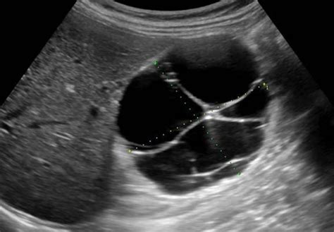 Urinary Tract and male reproductive system | 2.1 Kidney and ureter : Case 2.1.3 Renal cysts ...