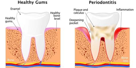 Stages of Periodontal Disease