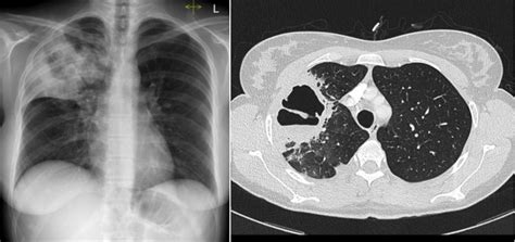 Cavitating pneumonia - Radiology at St. Vincent's University Hospital